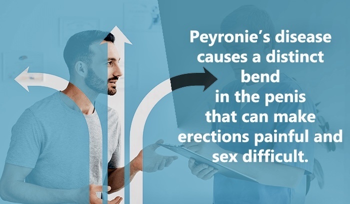 Η νόσος Peyronie είναι η κάμψη του πέους κατά την οποία υπάρχει αναλογική ασυμμετρία-δυσμορφία στην εμφάνιση, κυρίως κατά την στύση.