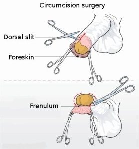 partial-circumsicion